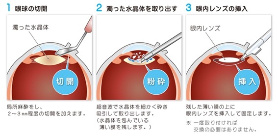 手術方法